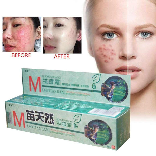 1 Pc Natural Germicidal Removel Cream Mite Moisturize Skin Cream Original Remove Acne Cream Ointment
